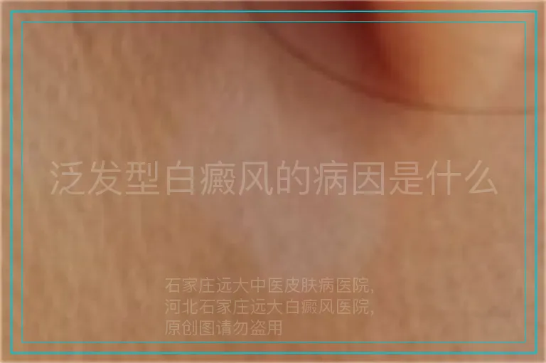泛发型白癜风的病因是什么