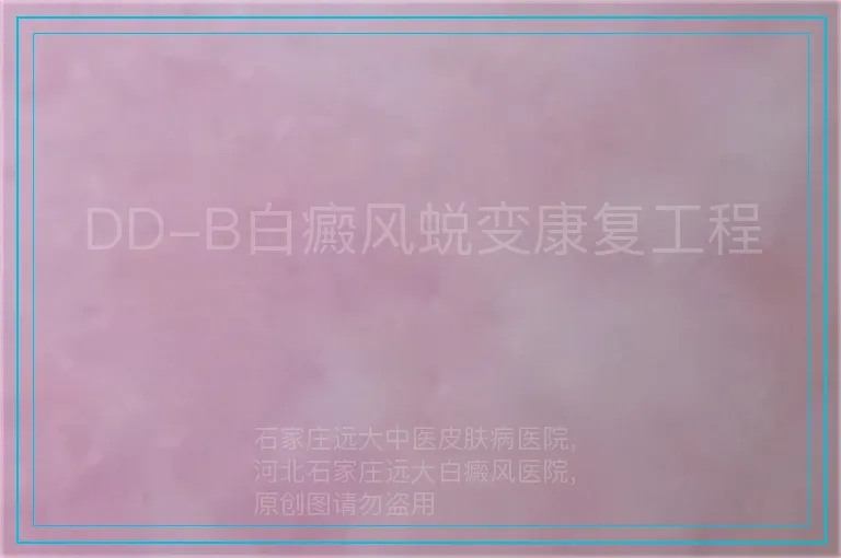 DD-B白癜风蜕变康复工程