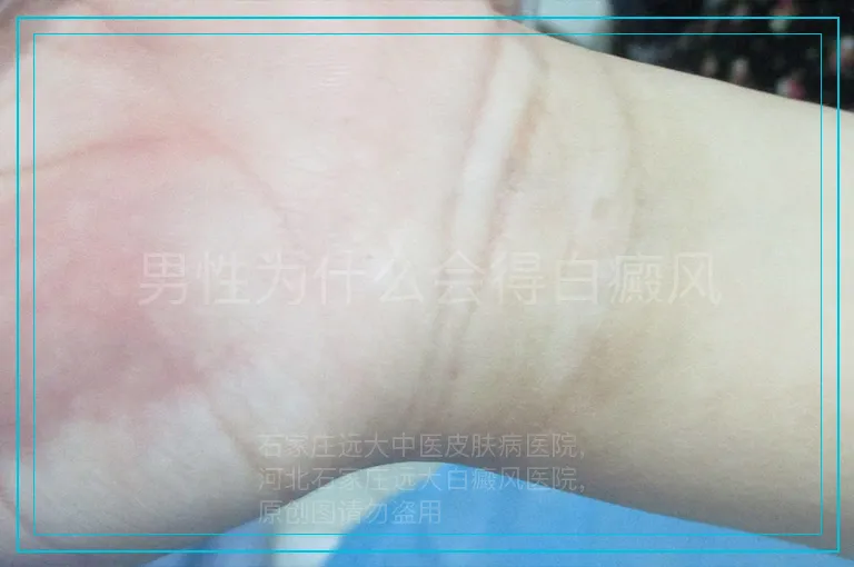 男性为什么会得白癜风