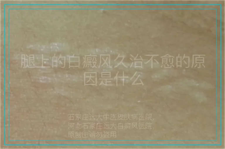 腿上的白癜风久治不愈的原因是什么