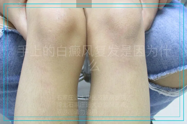手上的白癜风复发是因为什么