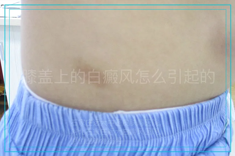 膝盖上的白癜风怎么引起的