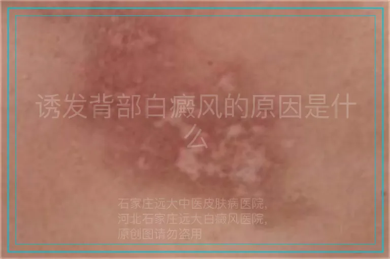 诱发背部白癜风的原因是什么
