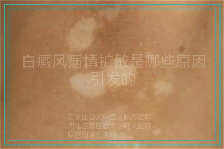 白癜风病情扩散是哪些原因引发的