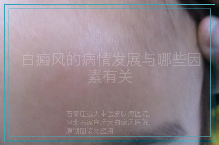 白癜风的病情发展与哪些因素有关