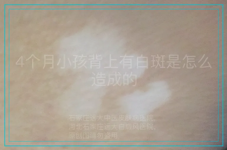 4个月小孩背上有白斑是怎么造成的