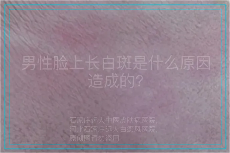 男性脸上长白斑是什么原因造成的?