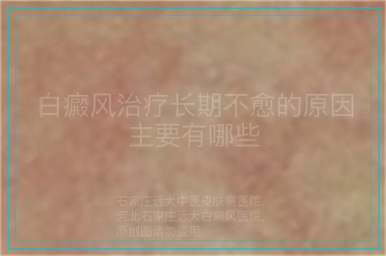 白癜风治疗长期不愈的原因主要有哪些