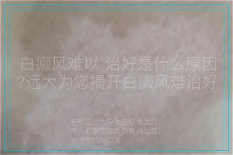 白癜风难以 治好是什么原因?远大为您揭开白癜风难治好之谜
