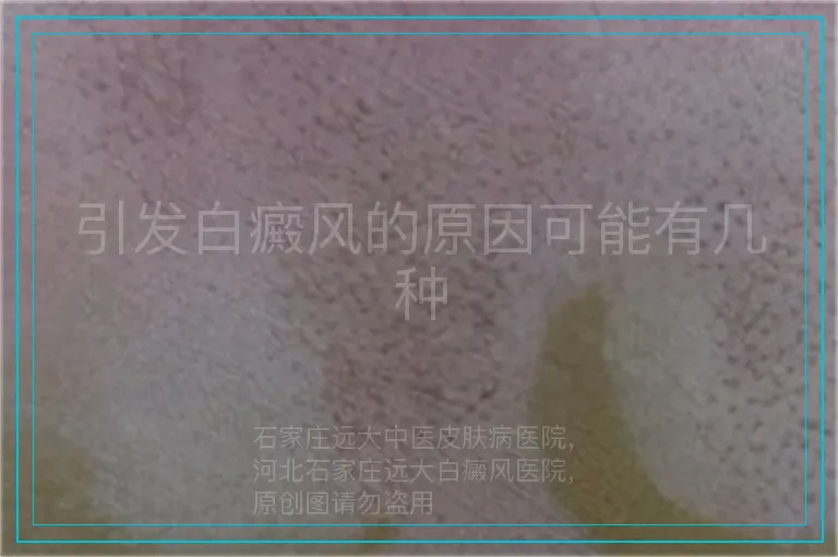 引发白癜风的原因可能有几种