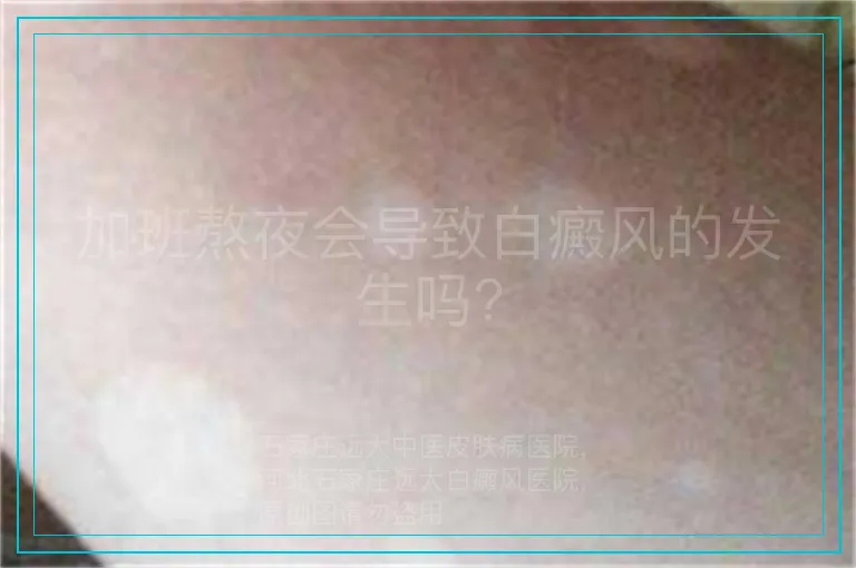 加班熬夜会导致白癜风的发生吗?