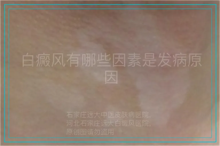 白癜风有哪些因素是发病原因
