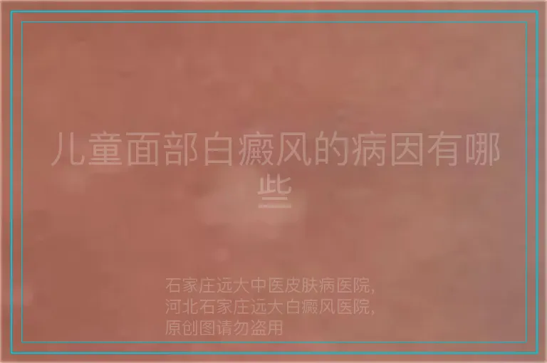 儿童面部白癜风的病因有哪些