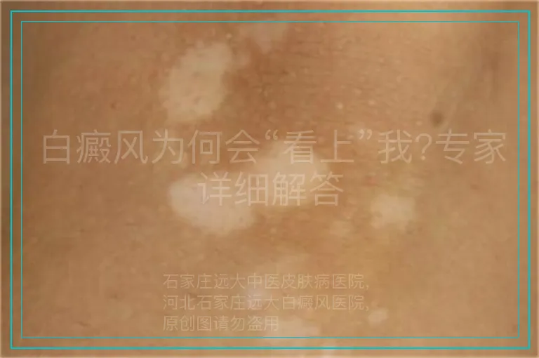 白癜风为何会“看上”我?专家详细解答