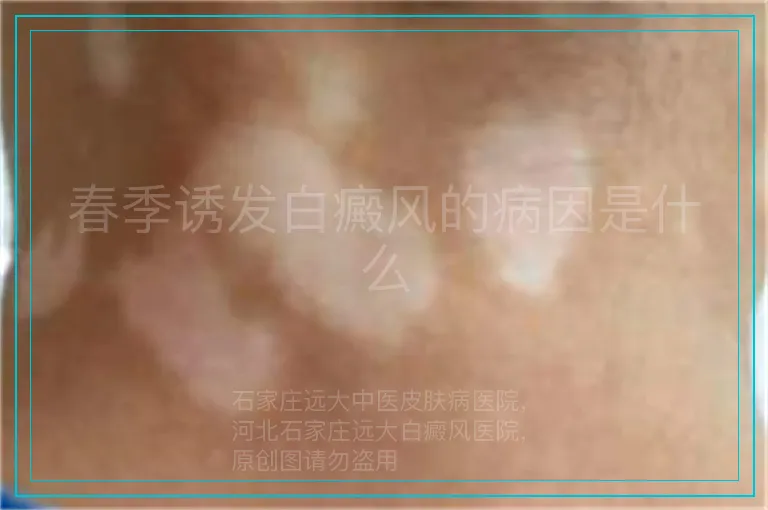 春季诱发白癜风的病因是什么