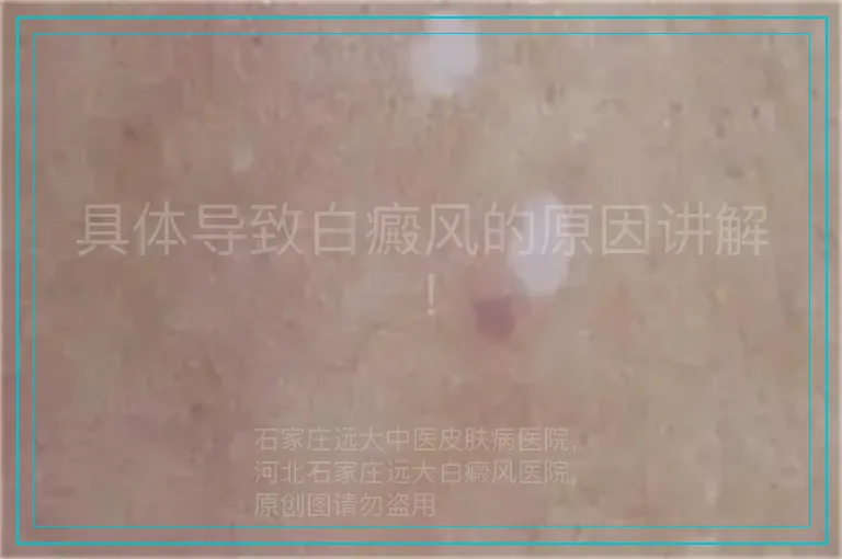 具体导致白癜风的原因讲解！
