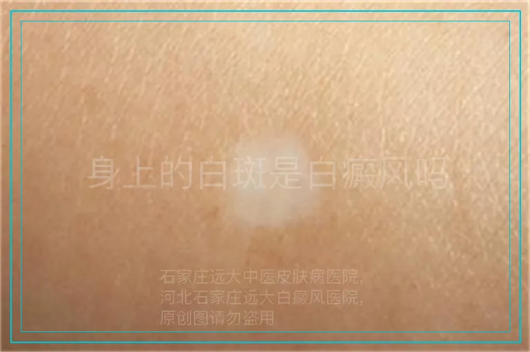 身上的白斑是白癜风吗
