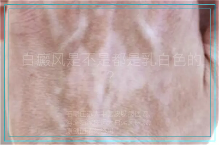 白癜风是不是都是乳白色的?