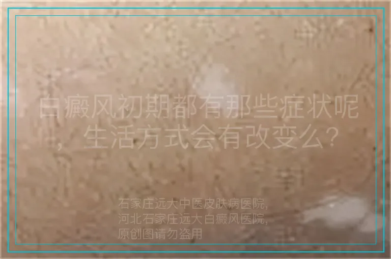 白癜风初期都有那些症状呢，生活方式会有改变么?