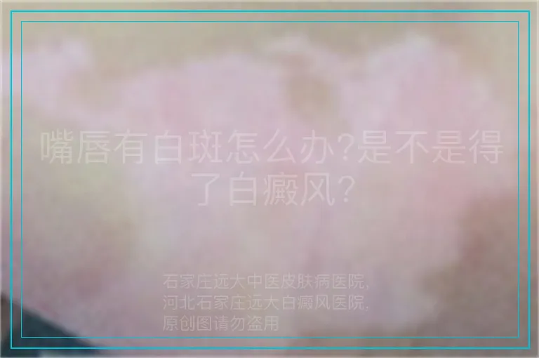 嘴唇有白斑怎么办?是不是得了白癜风?