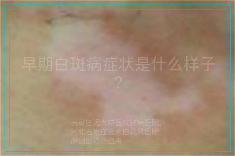 早期白斑病症状是什么样子?