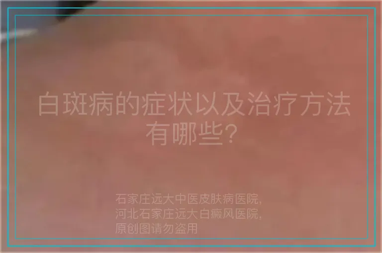白斑病的症状以及治疗方法有哪些?