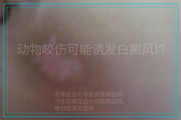 动物咬伤可能诱发白癜风!?