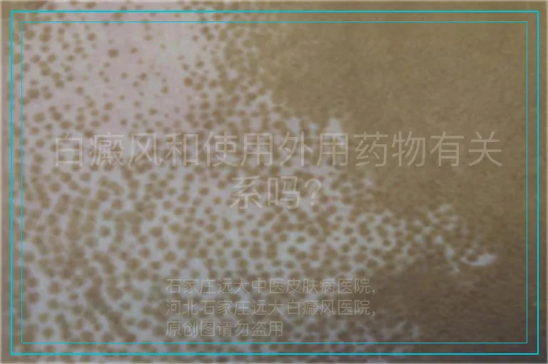 白癜风和使用外用药物有关系吗?