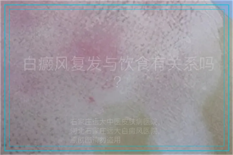 白癜风复发与饮食有关系吗?