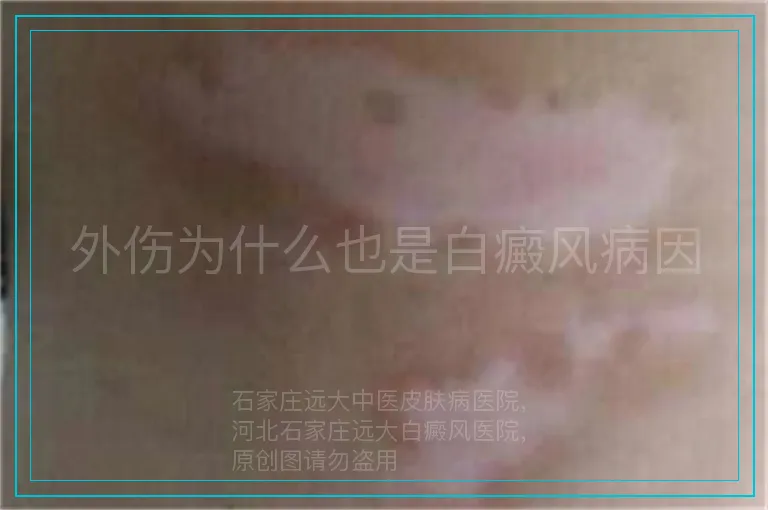 外伤为什么也是白癜风病因