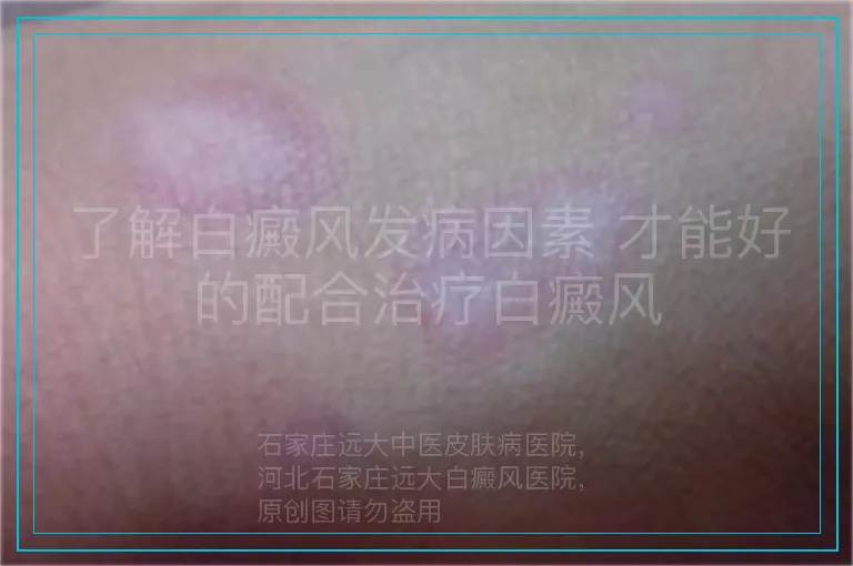 了解白癜风发病因素 才能好的配合治疗白癜风