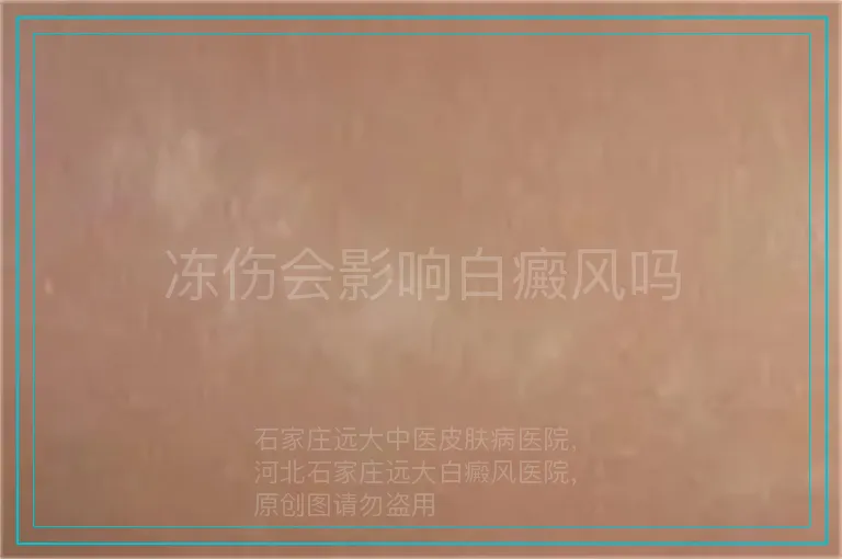 冻伤会影响白癜风吗