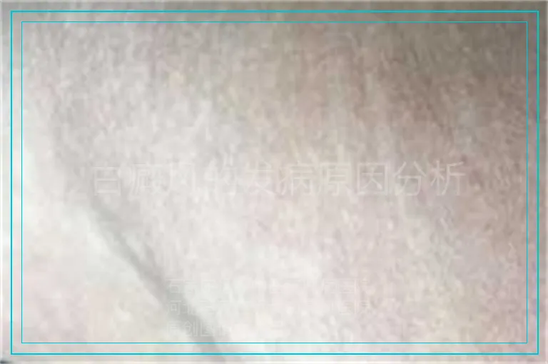 白癜风的发病原因分析