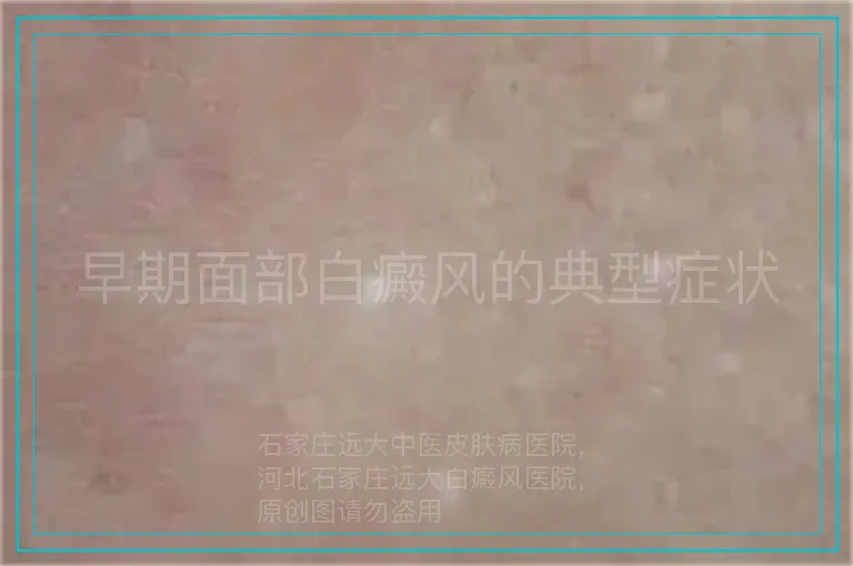 早期面部白癜风的典型症状