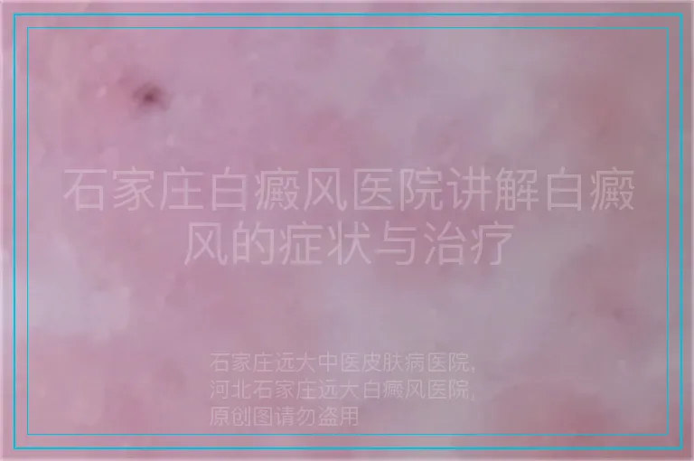 石家庄白癜风医院讲解白癜风的症状与治疗