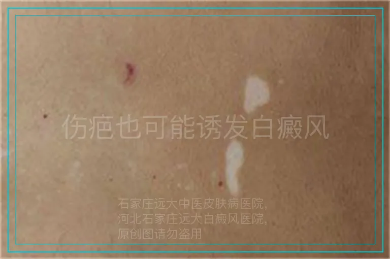 伤疤也可能诱发白癜风