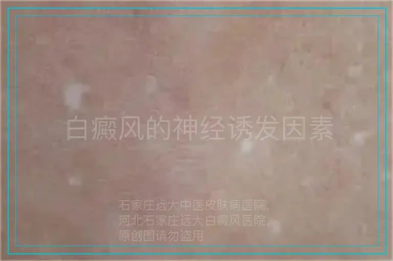 白癜风的神经诱发因素