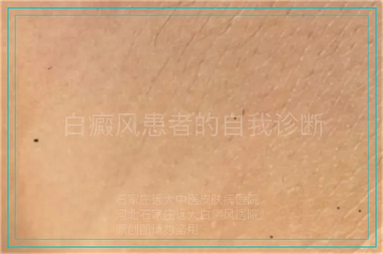 白癜风患者的自我诊断