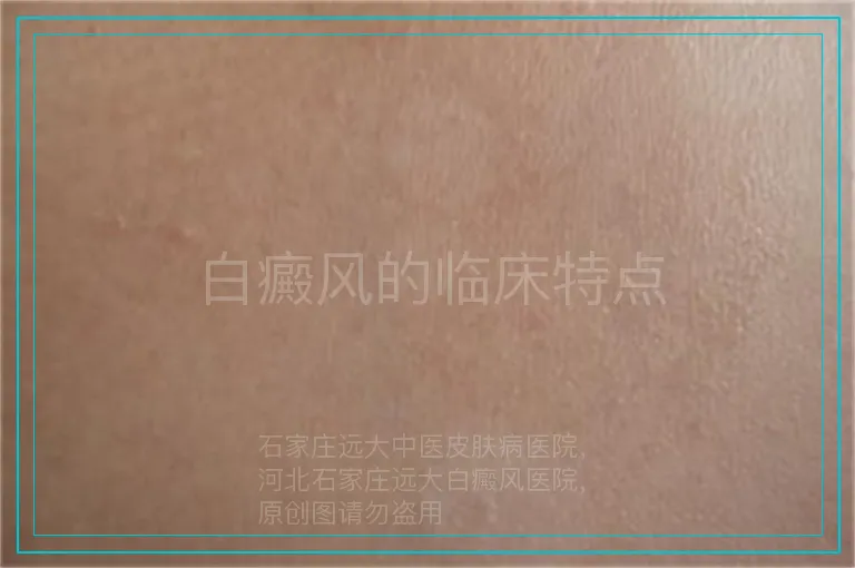 白癜风的临床特点