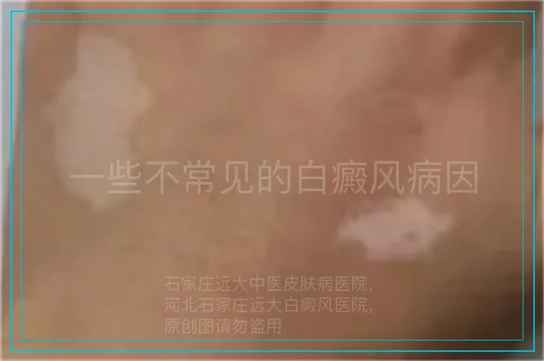 一些不常见的白癜风病因
