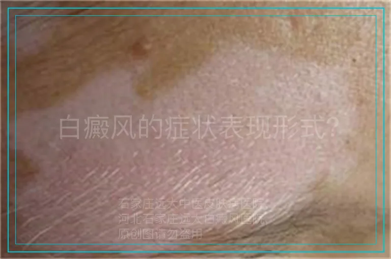 白癜风的症状表现形式？