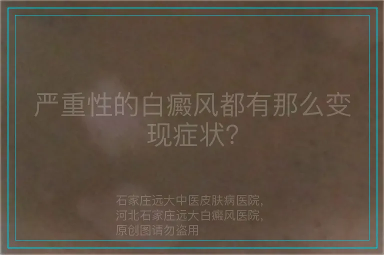 严重性的白癜风都有那么变现症状？