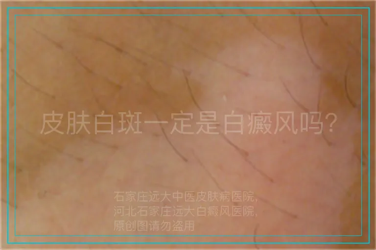 皮肤白斑一定是白癜风吗？