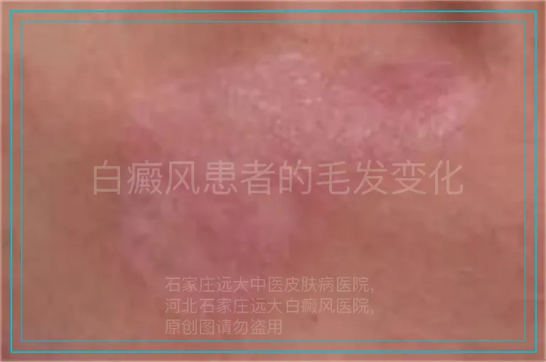 白癜风患者的毛发变化