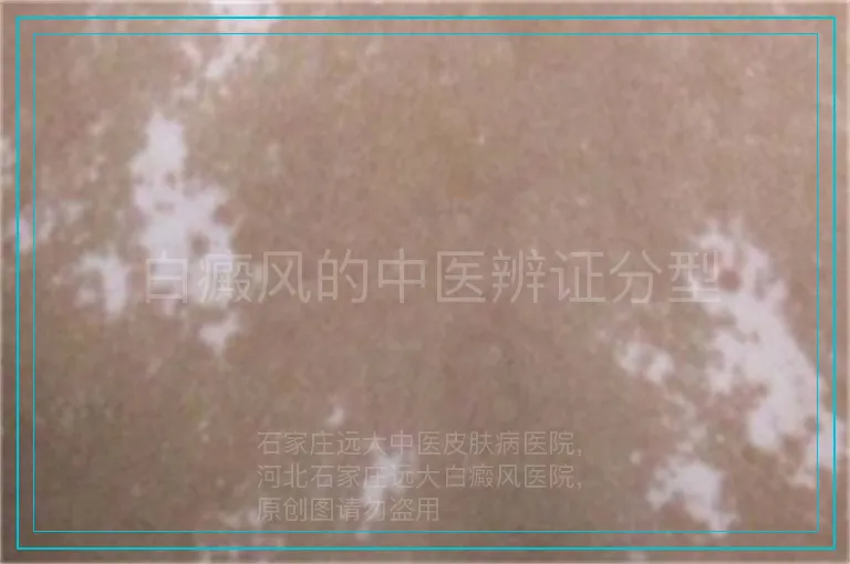 白癜风的中医辨证分型