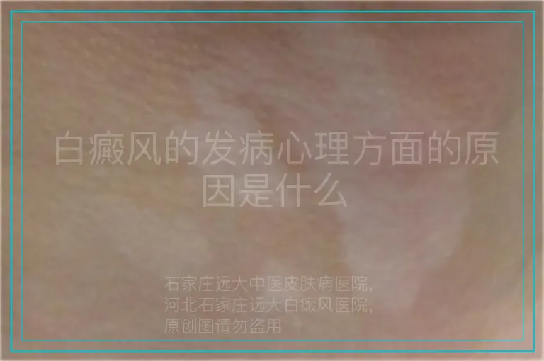 白癜风的发病心理方面的原因是什么