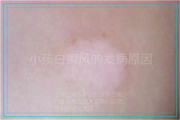 小孩白癜风的发病原因