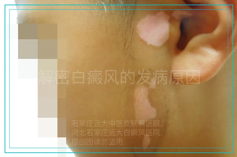 解密白癜风的发病原因