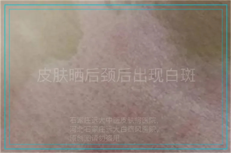 皮肤晒后颈后出现白斑