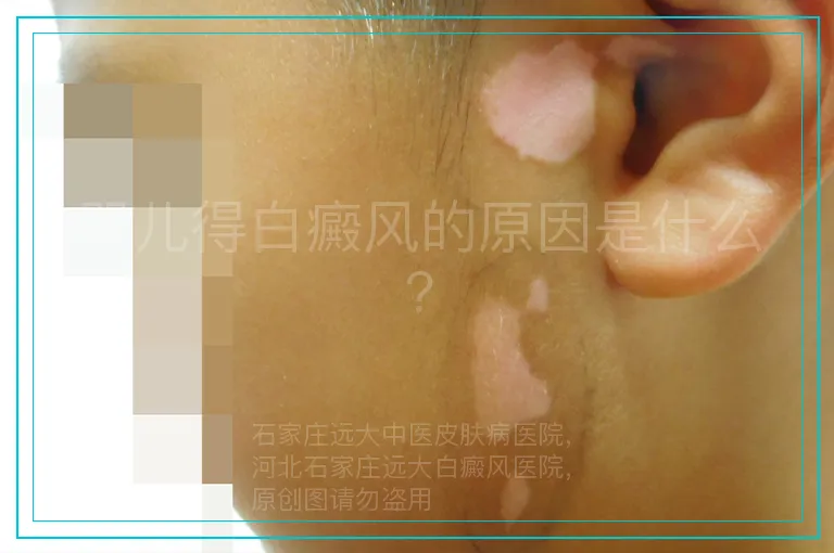 婴儿得白癜风的原因是什么?